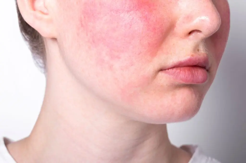Rosacea an der Wange