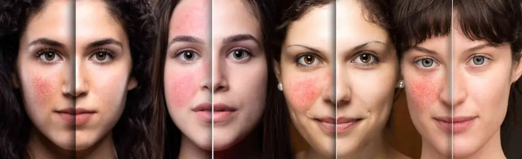 Rosacea 4 vorher nachher Bilder